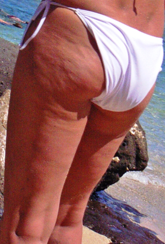 cellulitis behandelen
